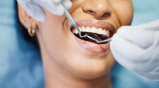 Best Knocked-Out Tooth (Avulsed Tooth) Treatment in Utica, MI